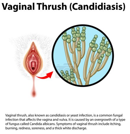 Illustration for Vaginal Thrush (Candidiasis) infographic with explanation illustration - Royalty Free Image