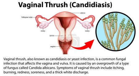 Vaginal Thrush (Candidiasis) infographic with explanation illustration