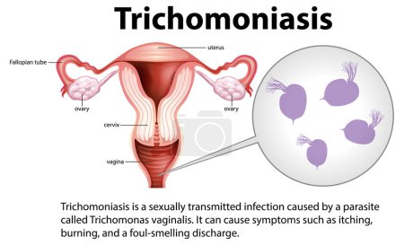Illustration for Trichomoniasis infographic with explanation illustration - Royalty Free Image