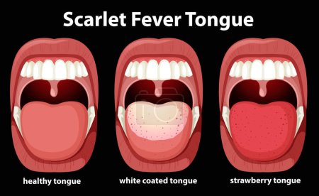 Téléchargez les illustrations : Scarlet fever tongue symptoms illustration - en licence libre de droit