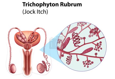Téléchargez les illustrations : Trichophyton Rubrum fungal infection illustration - en licence libre de droit