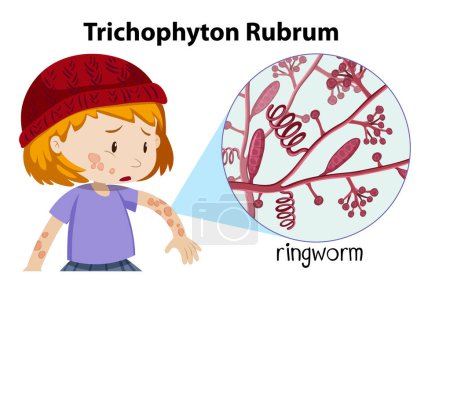 Illustration for Trichophyton Rubrum fungal infection illustration - Royalty Free Image