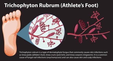 Illustration for Trichophyton Rubrum fungal infection illustration - Royalty Free Image