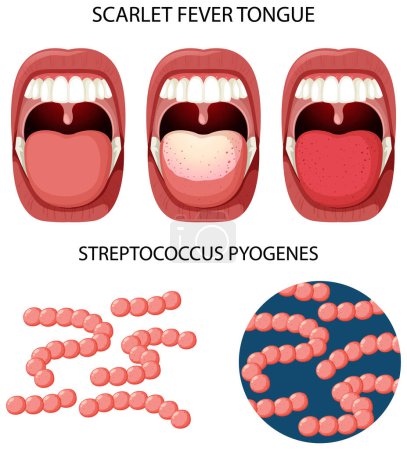 Illustration for Scarlet fever tongue symptoms illustration - Royalty Free Image