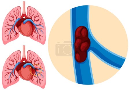 Téléchargez les illustrations : Human anatomy pulmonary embolism illustration - en licence libre de droit