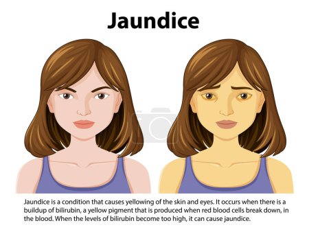 Illustration for Jaundice disease vector concept illustration - Royalty Free Image