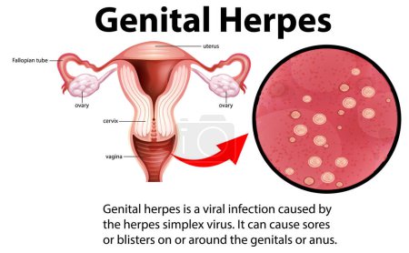 Ilustración de Genital Herpes infographic with explanation illustration - Imagen libre de derechos