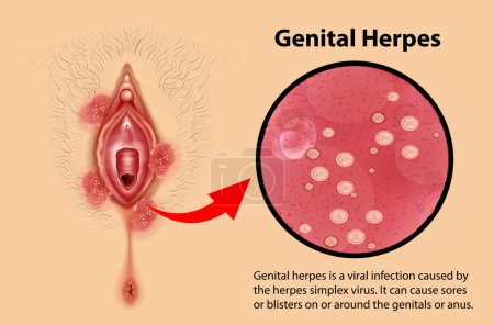 Ilustración de Genital Herpes infographic with explanation illustration - Imagen libre de derechos