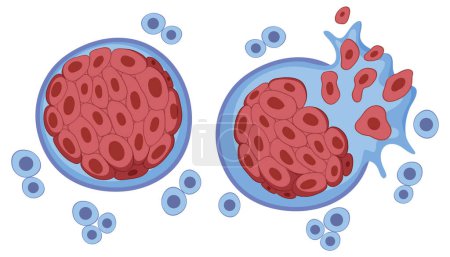 Ilustración del desarrollo de células tumorales y cáncer