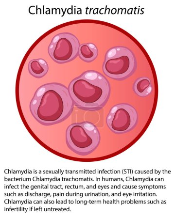 Illustration for Chlamydia trachomatis with explanation illustration - Royalty Free Image