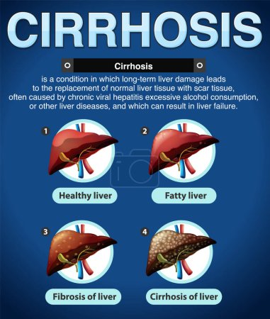Ilustración de Etapas de daño hepático Ilustración infográfica - Imagen libre de derechos