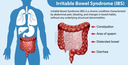 Ilustración de Síndrome del intestino irritable (SII) Ilustración infográfica - Imagen libre de derechos