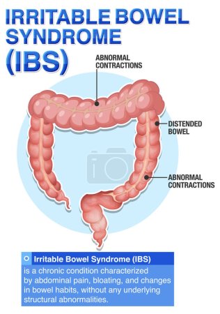 Syndrome du côlon irritable (SII) Illustration infographique