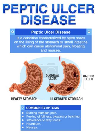 Ilustración de Enfermedad de úlcera péptica explicada ilustración infográfica - Imagen libre de derechos