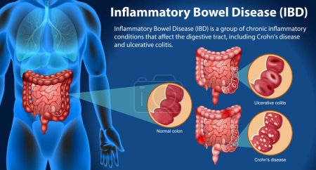 Inflammatory Bowel Disease (IBD) Infographic illustration