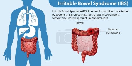 Ilustración de Síndrome del intestino irritable (SII) Ilustración infográfica - Imagen libre de derechos