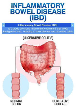 Ilustración de Enfermedad inflamatoria intestinal (EII) - Imagen libre de derechos