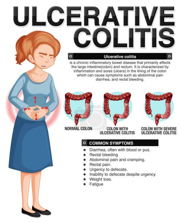 Ilustración de Colitis ulcerosa Síntomas Infografía ilustración - Imagen libre de derechos