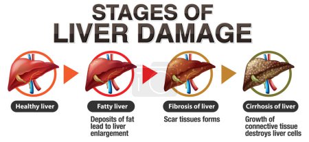 Illustration for Stages of Liver Damage Infographic illustration - Royalty Free Image