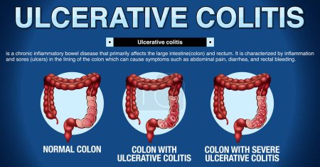Colitis ulcerosa Síntomas Infografía ilustración