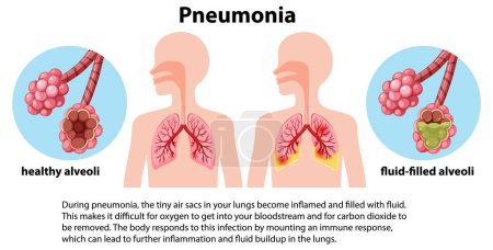 Ilustración de Neumonía por infección pulmonar con ilustración explicativa - Imagen libre de derechos