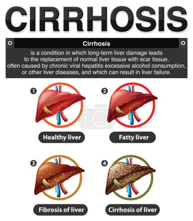 Illustration for Stages of Liver Damage Infographic illustration - Royalty Free Image