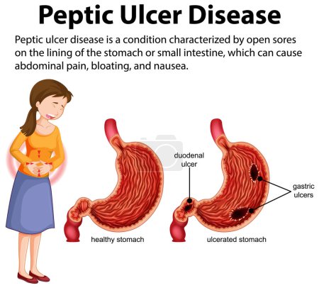 Ilustración de Enfermedad de úlcera péptica Infografía ilustración - Imagen libre de derechos