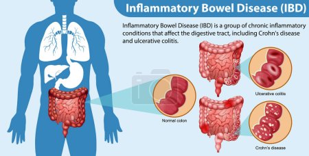 Maladie inflammatoire de l'intestin (MII) Illustration infographique