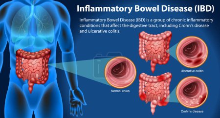 Illustration for Inflammatory Bowel Disease (IBD) Infographic illustration - Royalty Free Image