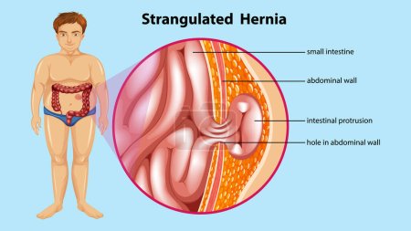 Illustration for Diagram showing Strangulated Hernia Anatomy illustration - Royalty Free Image