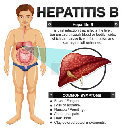 Illustration for Symptoms of Hepatitis B Infographic illustration - Royalty Free Image