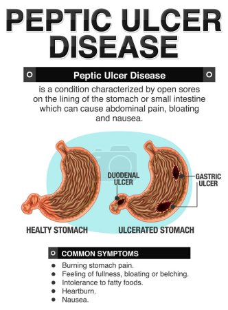 Ilustración de Enfermedad de úlcera péptica Infografía ilustración - Imagen libre de derechos