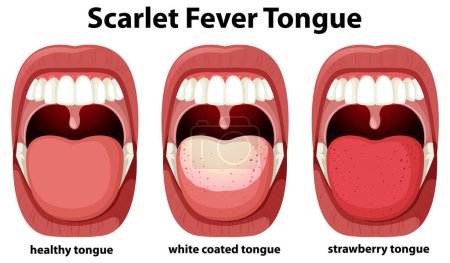 Illustration for Scarlet fever tongue symptoms illustration - Royalty Free Image