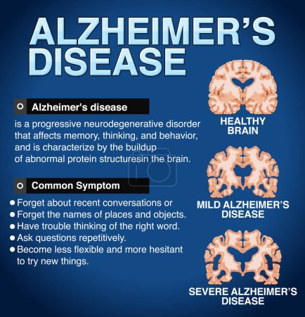 Téléchargez les illustrations : Affiche informative de l'illustration de la maladie d'Alzheimer - en licence libre de droit