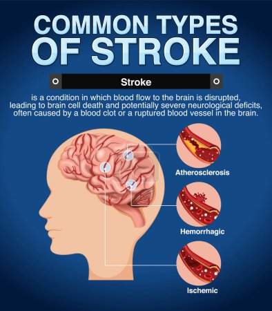 Informative poster of common types of stoke illustration