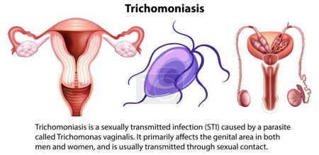 tricomoniasis