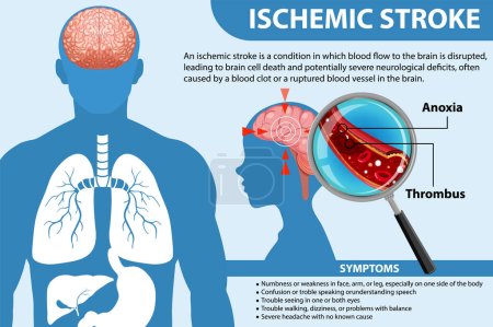 Informative poster of Ischemic stroke illustration