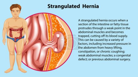 Illustration for Causes of Strangulated Hernia Infographic illustration - Royalty Free Image