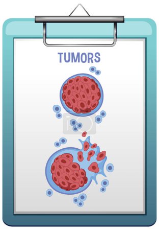 Illustration for Tumor cell and cancer development illustration - Royalty Free Image