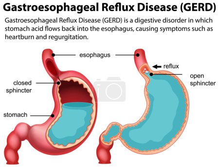 Ilustración de Enfermedad por Reflujo Gastroesofágico (ERGE) Diagrama ilustración - Imagen libre de derechos
