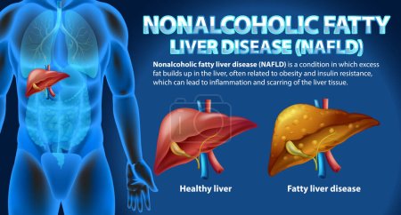 Illustration for Nonalcoholic Fatty Liver Disease (NAFLD) illustration - Royalty Free Image