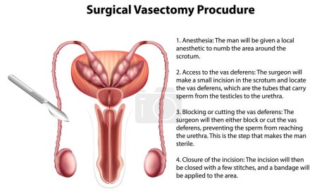 Illustration for Surgical Vasectomy Procudure infographic with explanation illustration - Royalty Free Image