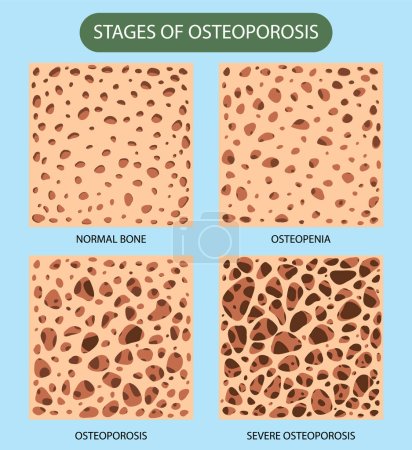 Densidad ósea y osteoporosis Vector ilustración