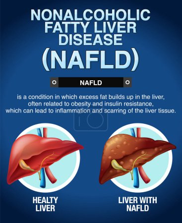Illustration for Nonalcoholic fatty liver disease illustration - Royalty Free Image