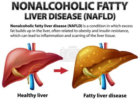 Illustration for Nonalcoholic Fatty Liver Disease illustration - Royalty Free Image