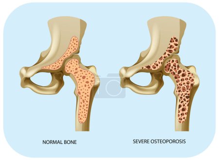 Téléchargez les illustrations : Densité osseuse et ostéoporose Illustration vectorielle - en licence libre de droit