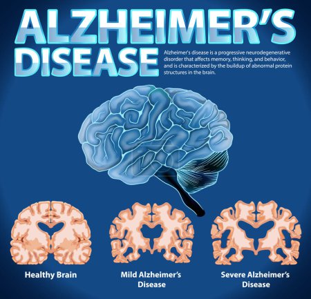 Ilustración de Cartel informativo de la enfermedad de Alzheimers ilustración - Imagen libre de derechos