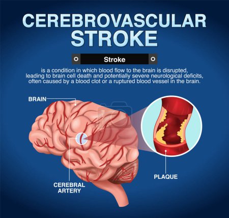 Ilustración de Cartel informativo de la ilustración Cerebrovascular stroke05 - Imagen libre de derechos