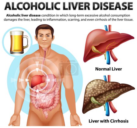 Téléchargez les illustrations : Affiche informative sur la maladie alcoolique du foie Illustration de la cirrhose - en licence libre de droit