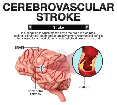 Illustration for Informative poster of Cerebrovascular stroke illustration - Royalty Free Image